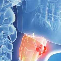 oncologia-testa-collo oncologia-testa-collo
